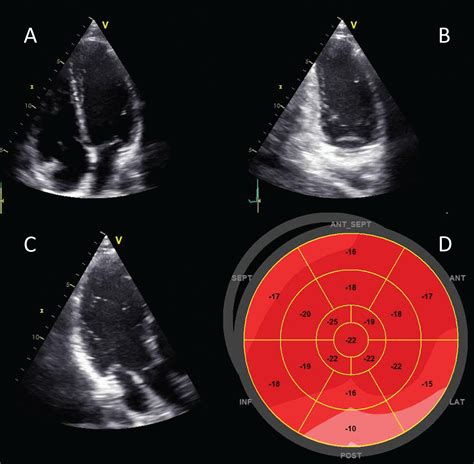 global lv systolic dysfunction|severe global Lv systolic dysfunction.